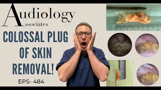 COLOSSAL 3CM/1.25 INCH EAR CANAL SKIN PLUG REMOVED - EP484