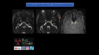 Sixth 6 th  cranial nerve anatomy and radiological approach