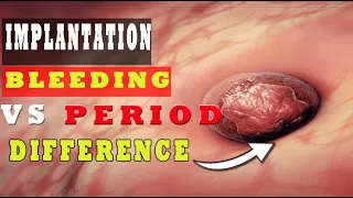 Implantation Bleeding Vs Period – (How to Know the Difference?) 🩸🩸