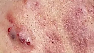 SAC DEP SPA Blackheads | #589