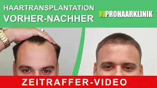 Haartransplantation vorher nachher: Georgios (Zeitraffer-video) - PROHAARKLINIK