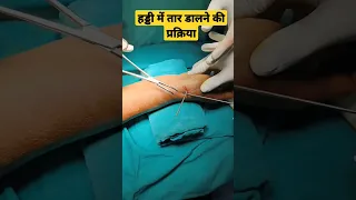 हड्डियों में तार कैसे डालते हैं | Wiring Technique in Fracture |#fracture #wristinjury #doctor #bone