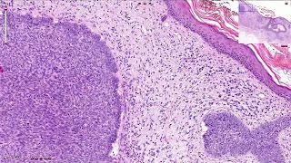 Basal Cell Carcinoma Including Variants - Histopathology