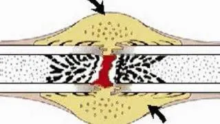 How the Body Works : Repair of Bone