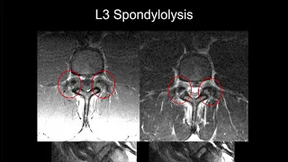 MRI of the Lumbar Spine | Part 9 - Lumbar Trauma