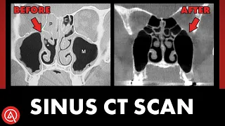 The Power and Insight of Sinus CT Scans