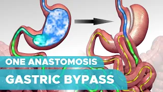 Types of Weight Loss Surgery: One Anastomosis Gastric Bypass Surgery (OAGB)