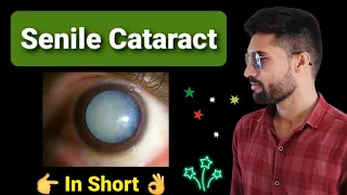 Senile cataract lecture opthalmology