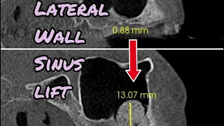 Lateral Wall Sinus Lift Step-by-Step