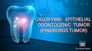 CALCIFYING EPITHELIAL ODONTOGENIC TUMOR (PINDBORGS TUMOR)