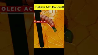 Believe ME! Dandruff can cause a serious Scalp "INFECTION" 😱 #shortsviral  #youtubeshorts#shortvideo