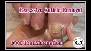 👣 How to Remove Excessive Cuticle Buildup, Callus Removal and Foot Massage 👣👍