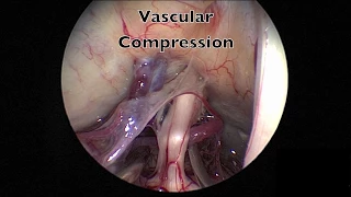 Endoscopic Microvascular Decompression for Trigeminal Neuralgia at Penn Medicine [Graphic content]