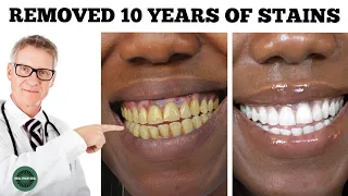 Teeth Whitening in just 16 minutes - Removes Yellowing and Accumulated Tartar? 100% Effective