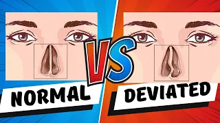 DEVIATED NASAL SEPTUM (DNS) EXPLAINED - CAUSE, DIAGNOSIS, ANATOMY, TYPES, TREATMENT