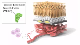 Progression of wet Age-Related Macular Degeneration