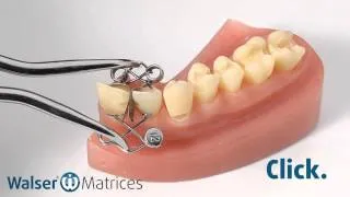Walser® Sectional Matrix system: Application XF-form dental matrix