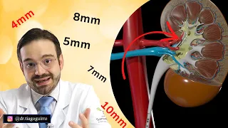 Expelir Cálculo Renal Sem Cirurgia! É Possível!?