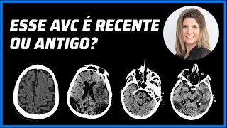 COMO É A EVOLUÇÃO DO AVC NA TOMOGRAFIA COMPUTADORIZADA