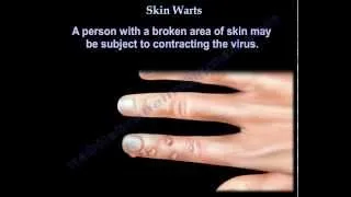 Skin Warts , Hand warts - Everything You Need To Know - Dr. Nabil Ebraheim