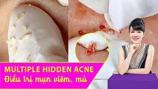 Hidden Acne | Điều trị mụn ẩn, mụn đầu đen hiệu quả số 1 TPHCM | Hiền Vân spa|562