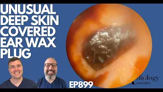 UNUSUAL DEEP SKIN COVERED EAR WAX PLUG - EP899
