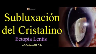 Subluxación del Cristalino. Ectopia Lentis.