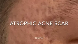 Acne scar punch excision