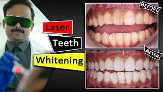 Teeth Whitening With Laser | Fastest & Safest way