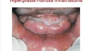 hiperplasia