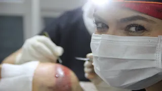 Haartransplantationsfilm mit allen Details