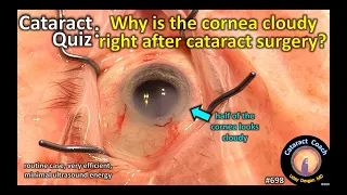 Cataract Quiz: Why is the cornea cloudy right after cataract surgery?