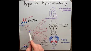 Type 3 hypersensitivity reaction in 2 mins!