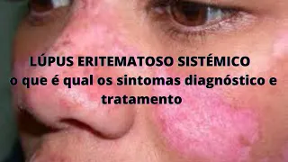 LÚPUS ERITEMATOSO SISTÉMICO  o que é qual os sintomas diagnóstico e tratamento