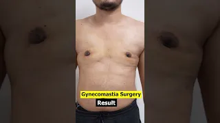 Cost of Gynecomastia Surgery | Dressing removal & RF Session #shorts