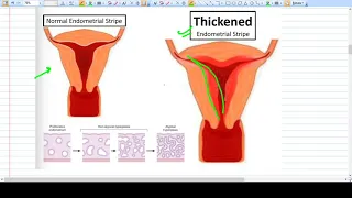 ENDOMETRIAL HYPERPLASIA concept and Management