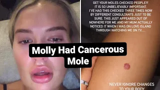 Love Island's Molly Mae Finds out her mole was cancerous