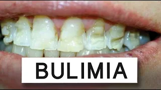 What Bulimia Does To Your Mouth