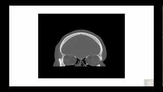 Bony orbital and skull base anatomy pathology in Coronal Plane