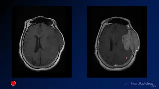 Emergency Imaging of Brain Tumors: Non-gliomas