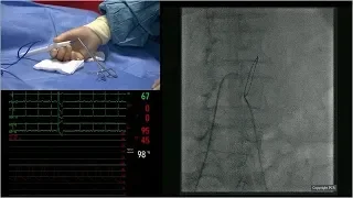 LIVE transcaval TAVI at PCR London Valves 2018