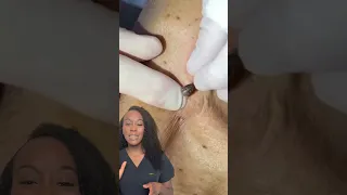 Blackhead Removal 101