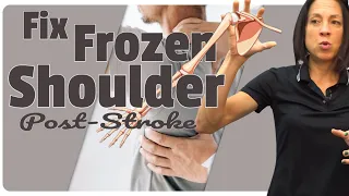 Frozen Shoulder Post-Stroke