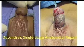 Devendra's Anatomical Single-stage Repair for  Penoscrotal Hypospadias with Severe Chodee