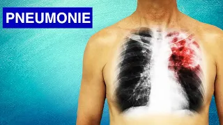 Pneumonie : Symptômes, Diagnostic et Traitements