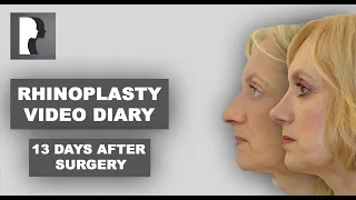 Rhinoplasty video diary – 13 days after surgery (13/14)