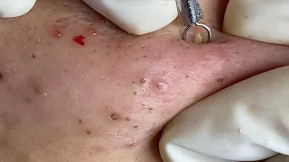 THE SUPER BLACKHEADS POPS | Suri Job 135