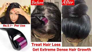 I used Dermarolling👆🏼on Bald scalp & Got Unstoppable Extreme Hair Growth-Double Density & Thickness