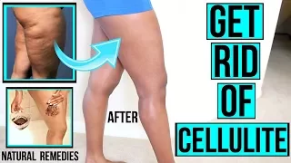HOW TO GET RID OF CELLULITE FAST & NATURALLY + DIY AT HOME SCRUBS & MIXES