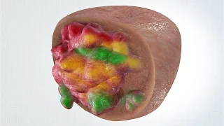 Tumour heterogeneity in prostate